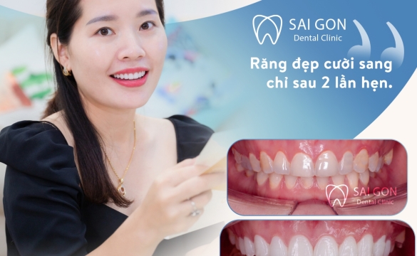 TRỒNG RĂNG IMPLANT CÓ BỊ HÔI MIỆNG KHÔNG?