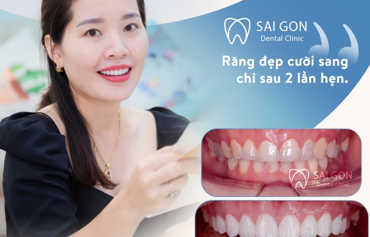 TRỒNG RĂNG IMPLANT CÓ BỊ HÔI MIỆNG KHÔNG?